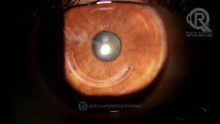 Keratokonus  Stromal halqa corneal ring  Oftalmoloq Dr Rəşadət Qurbanov [upl. by Bowyer334]