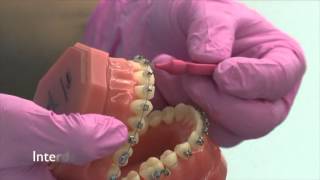 Caring For Your Fixed Brace  Family Orthodontics Cambridge [upl. by Ytsirk167]