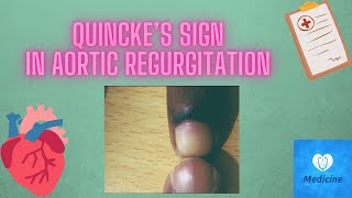 Quincke’s sign  Aortic regurgitation  medicine physical examination [upl. by Anitsuga]