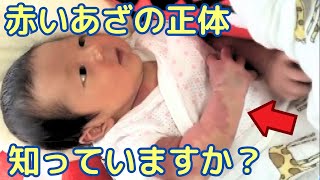 【単純性血管腫】偏見を乗り越えて…12歳の少年が支援の場へ [upl. by Kabob]