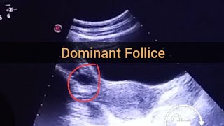 Ultrasound shows Dominant follicle inside Right ovary [upl. by Ydnolem]