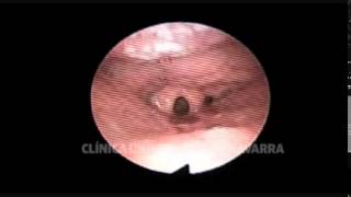 DISE Epiglotis Cierre sobre mismo [upl. by Notrem597]