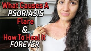 WHAT CAUSES A PSORIASIS FLARE amp HOW TO HEAL IT FAST [upl. by Odareg]