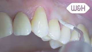 Tigon and periodontology tips 1P 1I English [upl. by Gabie556]