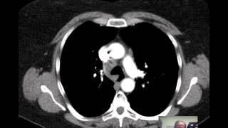 Lungs  gross anatomy [upl. by Anilef]