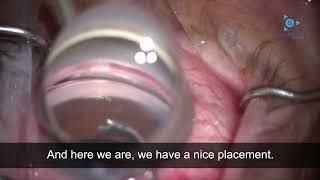 Cataract Surgery Tutorial How to Perform a Hydrus Implant Placement in Glaucoma Surgery [upl. by Notecnirp]