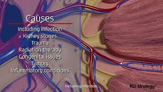 Ureteral Stricture  KU Urology [upl. by Jacobs]