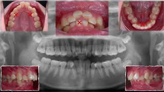 Chris Top 11 Cases 4 Class II Excessive Overjet and Deep Bite｜【Chris Chang Ortho】CC456 [upl. by Leerzej510]