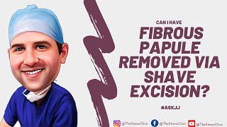 Can I have a fibrous papule removed via shave excision [upl. by Lennie]