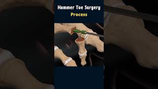 Hammer Toe Surgery Understanding the Procedure surgeryanimation [upl. by Eibreh206]