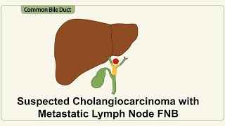 Suspected cholangiocarcinoma with Metastatic Porta Hepatis Lymph Nodes [upl. by Burnsed]