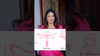 क्या Bicornuate uterus में Pregnancy हो सकती है sonaamedihub drsonalparihar gynaecologist [upl. by Gilpin842]