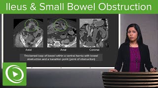 Bowel Obstruction and Ileus Ileus amp Small Bowel Obstruction – Radiology  Lecturio [upl. by Gilbertine]