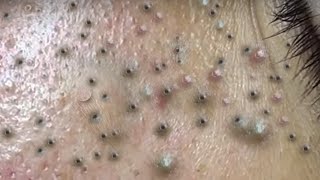 Big Cystic Acne Blackheads Extraction Blackheads amp Milia Whiteheads Removal Pimple Popping  4191 [upl. by Jardena454]