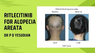 Ritlecitinib for alopecia areata [upl. by Chambers]