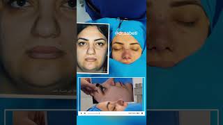 Nose job in IRanDrSabetinose nosejobfacelift [upl. by Nauqet630]