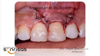 Apicectomia realizado en el Consultorio Dental Sonrisas por la Dra Angela Gaibor Duran [upl. by Longmire]