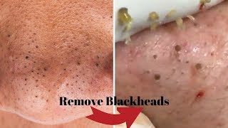 Remove Your Blackheads using these Techniques Naturally Home Remedies [upl. by Seravart]