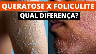 QUAL A DIFERENÇA ENTRE QUERATOSE PILAR E FOLICULITE  SAIBA [upl. by Nosyrb]