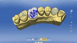 CEREC 40 Introduction [upl. by Anilek]