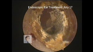 Ear wax removal and Fungal cleaning 20230717 [upl. by Nnaeerb]