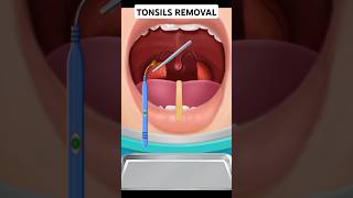 Tonsil Removal tonsilitis tonsils [upl. by Werd887]