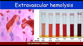 Lecture 213 Extravascular hemolysis [upl. by Euginimod]