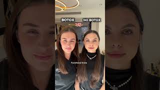 BOTOX VS NO BOTOX antiaging botulinumtoxin [upl. by Akemaj]