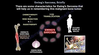 Ewings Sarcoma Briefly  Everything You Need To Know  Dr Nabil Ebraheim [upl. by Revlis154]