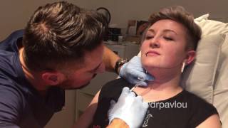 Chin Reduction Procedure using Belkyra [upl. by Atlee6]