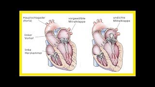Symptome von Mitralklappenprolaps [upl. by Orelle338]