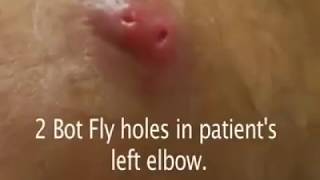 Big Botfly Removal From Human Skin [upl. by Sura]