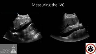 POCUS Cases 4 IVC POCUS for volume status [upl. by Aleb]