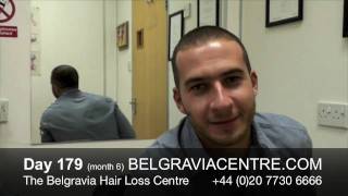 Hair Loss Treatment Video Diary Month 6  Diya [upl. by Simons]