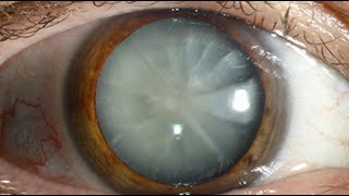 Potential of Hydrogen Inhalation Therapy for Cataract Management [upl. by Shaer]