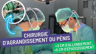 Chirurgie dagrandissement du pénis 3 cm dallongement 5 cm dépaississement [upl. by Julio]