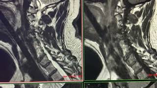 Enfermedad de segmento adyacente en columna cervical [upl. by Tybalt994]