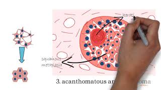 Ameloblastoma part 2 [upl. by Brownley]