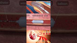 Coronary angioplasty  heart angiogram angioplasty heartattack nursingking [upl. by Tyrus]