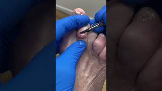 Say goodbye to painful corns amp calluses Watch how an expert Aussie podiatrist works magic on a 2nd [upl. by Ianthe]