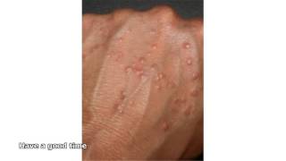 granuloma annulare treatment [upl. by Silvie484]