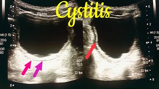 Cystitis kya hota hai  cystitis in children  cystitis symptoms  cystitis ultrasound [upl. by Maia536]