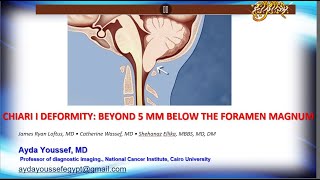 Chiari I Deformity Beyond 5 mm below the Foramen Magnum part1 [upl. by Priebe]