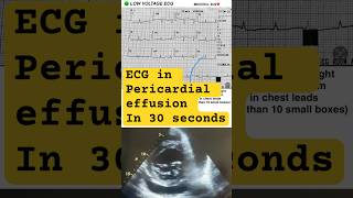 Pericardial effusion ECG echocardiogram echocardiography ecg cardiology donuts donut [upl. by Kaitlin]