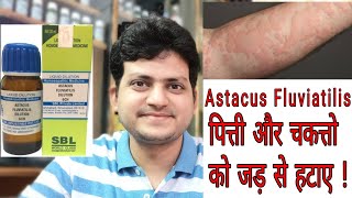 Homeopathic medicine Astacus Fluviatilis  Sign amp Symptoms  पित्ती और चकत्ते की दवा  Urticaria [upl. by Melamed651]