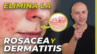 Rosácea Y Dermatitis Así Se Cura  Dr Carlos Jaramillo [upl. by Blader558]