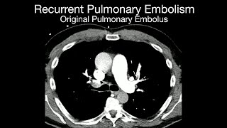 Recurrent Pulmonary Embolism [upl. by Barber]