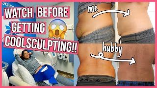 SHOCKING Coolsculpting Before amp After 6 Things You NEED to Know [upl. by Felise]