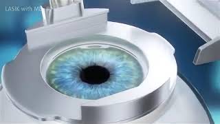 LASIK Surgery เลสิคเป็นมาตรฐานการรักษาภาวะสายตาผิดปกติที่ได้รับการยอมรับในระดับสากลกว่า 20 ปี [upl. by Legir560]