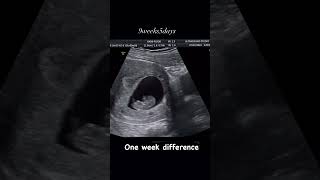 9 week baby movement in womb pregnancy ultrasound pregnancycare [upl. by Medora627]